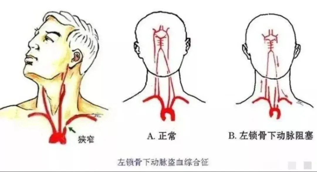 【健康科普】身体里边流淌的血液还能被盗走？——盗血综合征