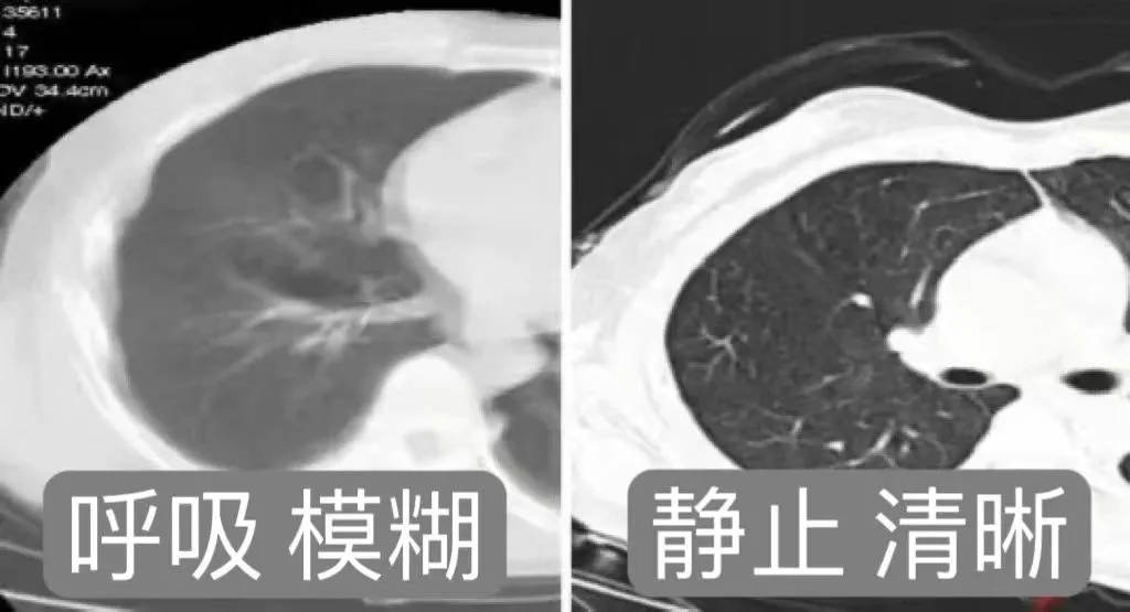 【健康科普】胸部CT检查时，您学会吸气、憋气、呼气了么？
