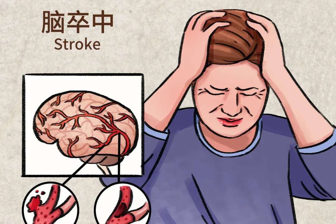 【健康科普】脑卒中早期康复：良肢位摆放方法